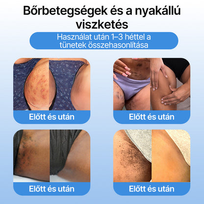 FFBSI® CoolErase Bőrregeneráló Spray (Szemölcsök, Hólyagok, Ekcéma, Pikkelysömör, Bőrkinövések, Akne, Bőrcímkék, Hegek, Anyajegyek)