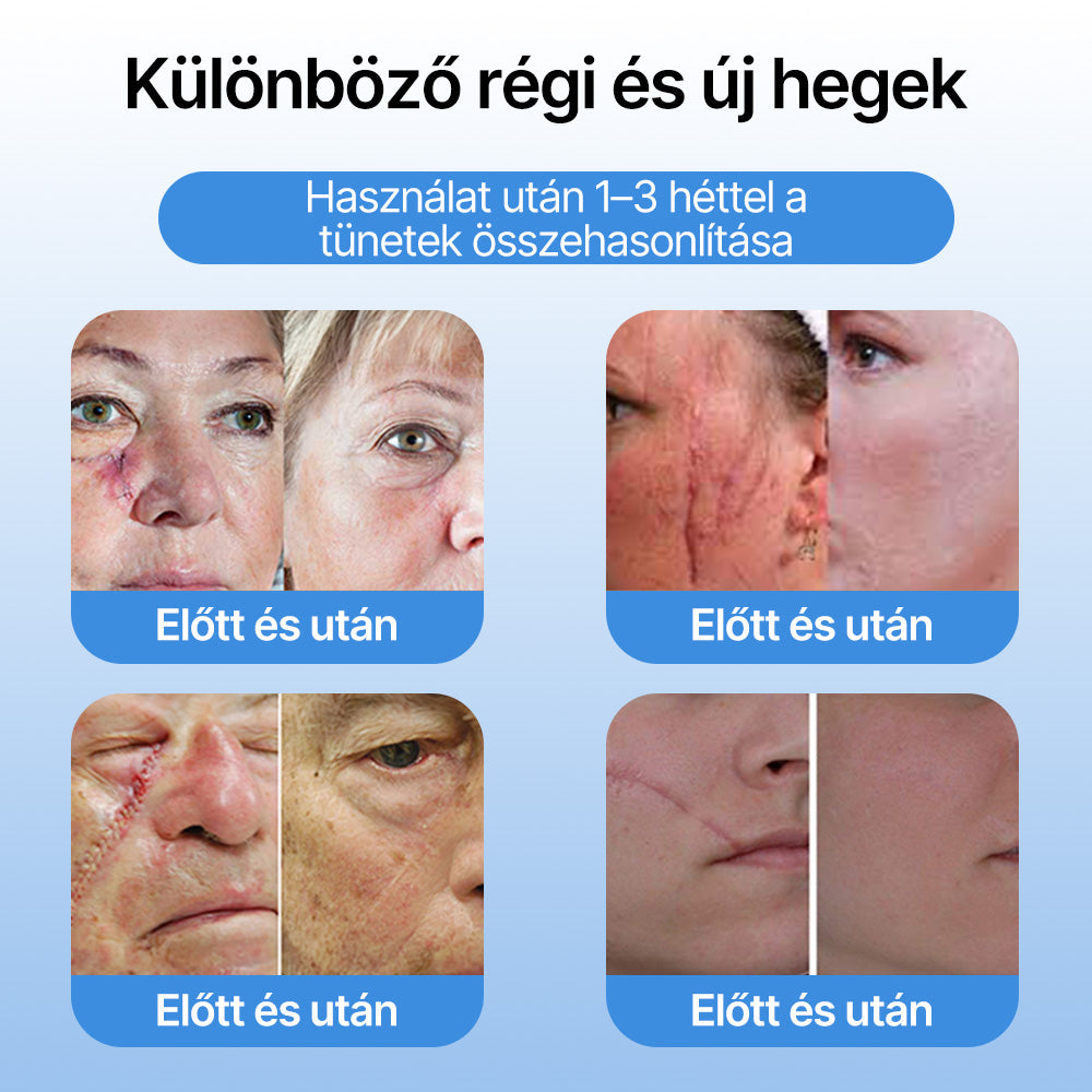 FFBSI® ❄ CoolErase Bőrregeneráló Spray (Szemölcsök, Hólyagok, Ekcéma, Pikkelysömör, Bőrkinövések, Akne, Bőrcímkék, Hegek, Anyajegyek)