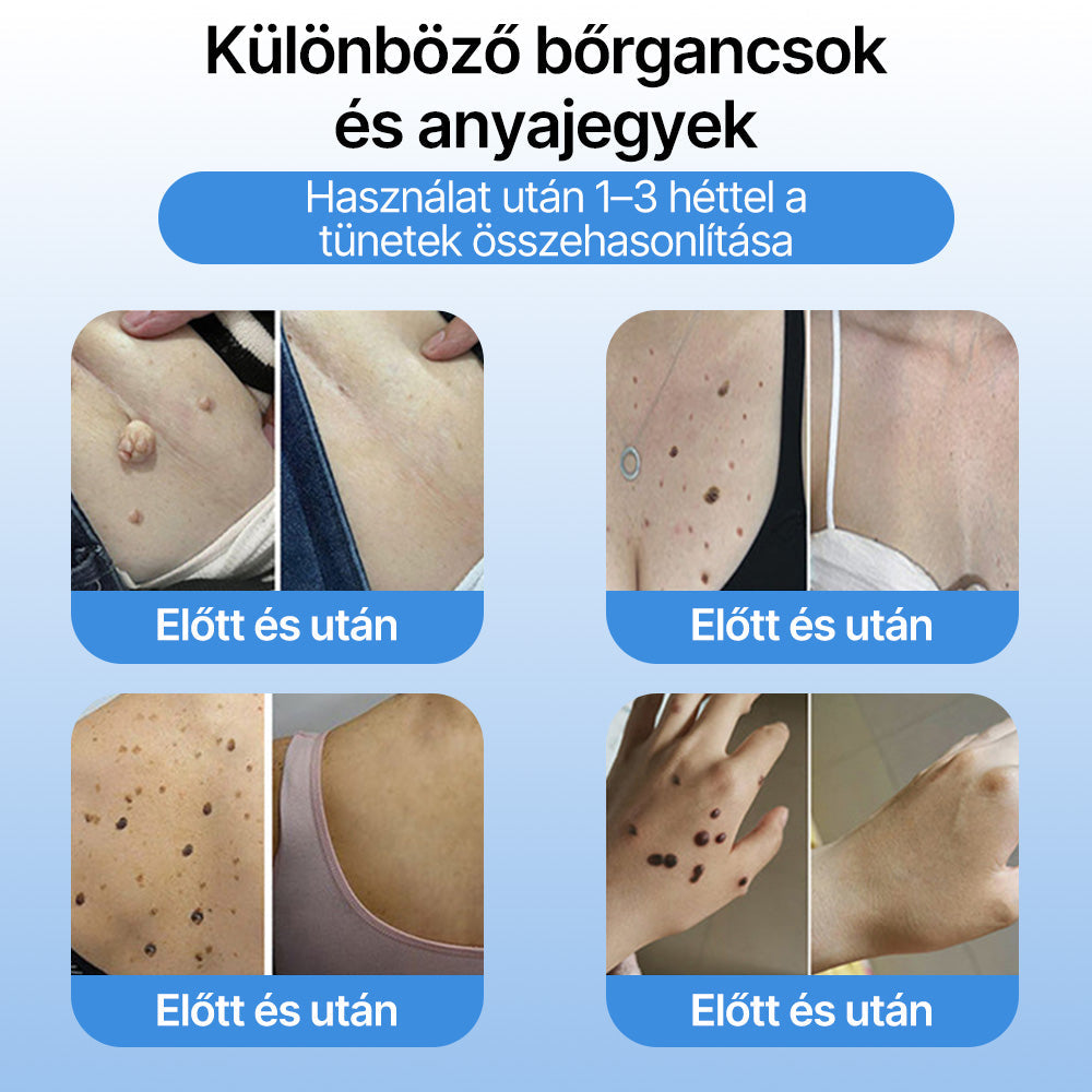 FFBSI® 🧊 CoolErase Bőrregeneráló Spray (Szemölcsök, Hólyagok, Ekcéma, Pikkelysömör, Bőrkinövések, Akne, Bőrcímkék, Hegek, Anyajegyek)