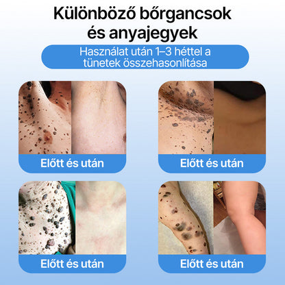 FFBSI® 🧊 CoolErase Bőrregeneráló Spray (Szemölcsök, Hólyagok, Ekcéma, Pikkelysömör, Bőrkinövések, Akne, Bőrcímkék, Hegek, Anyajegyek)