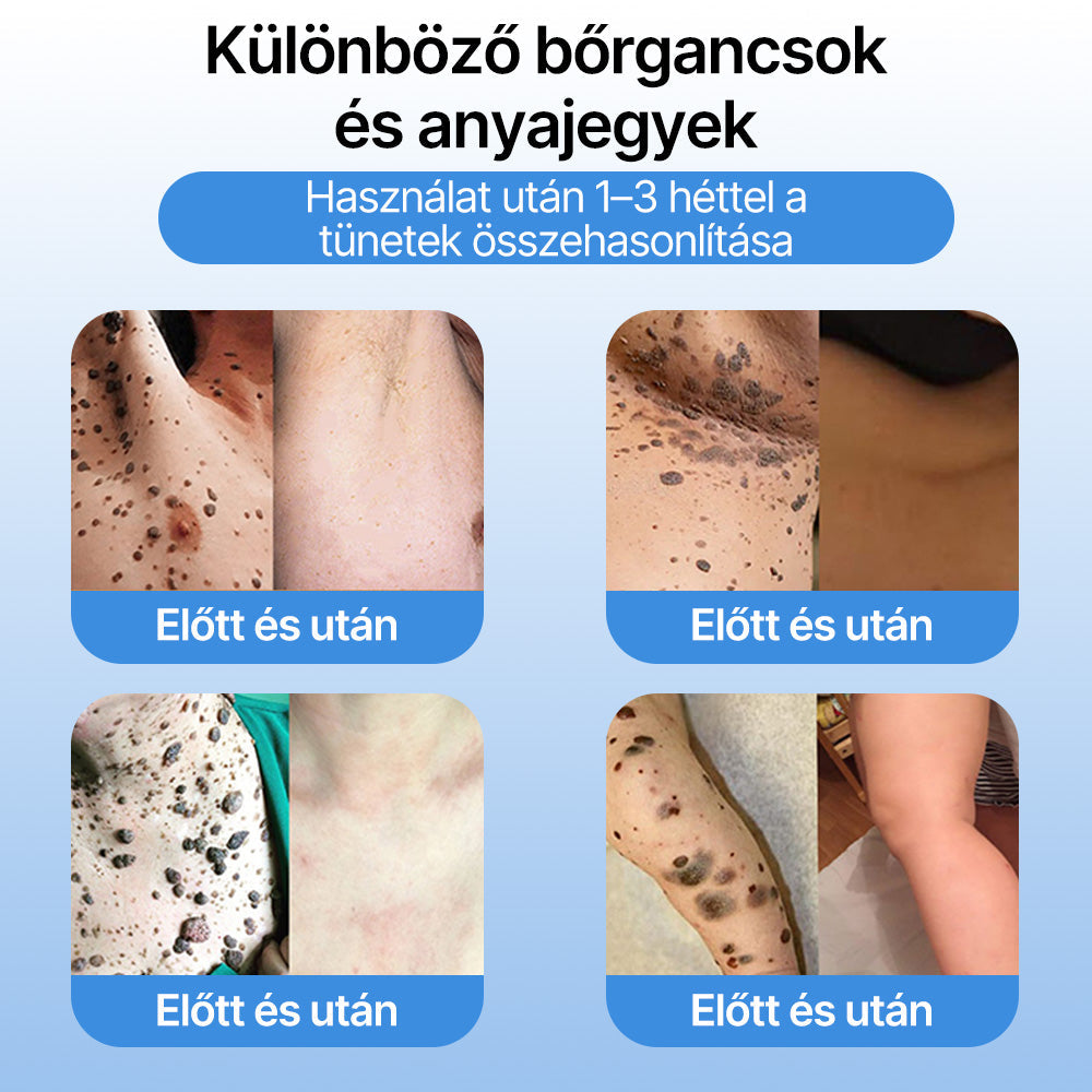 FFBSI® ❄ CoolErase Bőrregeneráló Spray (Szemölcsök, Hólyagok, Ekcéma, Pikkelysömör, Bőrkinövések, Akne, Bőrcímkék, Hegek, Anyajegyek)
