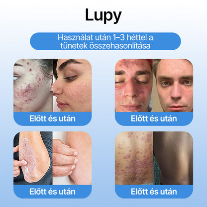 FFBSI® 🧊 CoolErase Bőrregeneráló Spray (Szemölcsök, Hólyagok, Ekcéma, Pikkelysömör, Bőrkinövések, Akne, Bőrcímkék, Hegek, Anyajegyek)