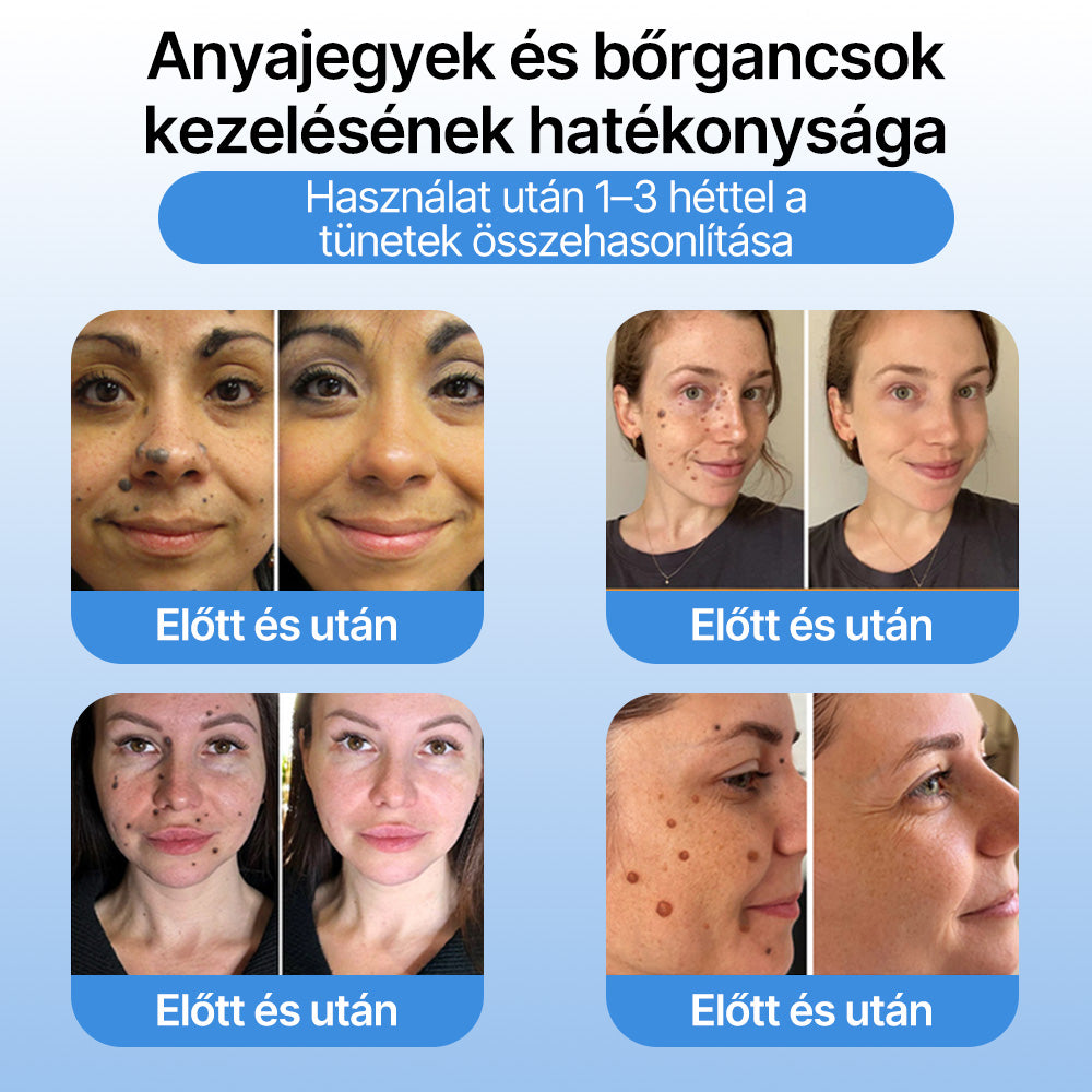 FFBSI® ❄ CoolErase Bőrregeneráló Spray (Szemölcsök, Hólyagok, Ekcéma, Pikkelysömör, Bőrkinövések, Akne, Bőrcímkék, Hegek, Anyajegyek)