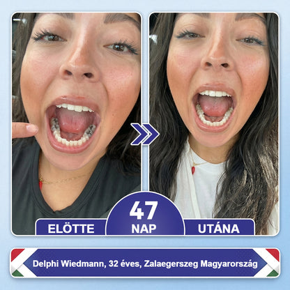 🦷HAJUEI® Tideglusib Fog & íny Javító mikrotűs tapasz | Fejlett őssejt-aktiváló fogcsíkok (újjáépíti a fogzománcot és a dentint • erősíti az ínyt • megszünteti a fogkövet és a szagokat • megállítja a fogérzékenységet)