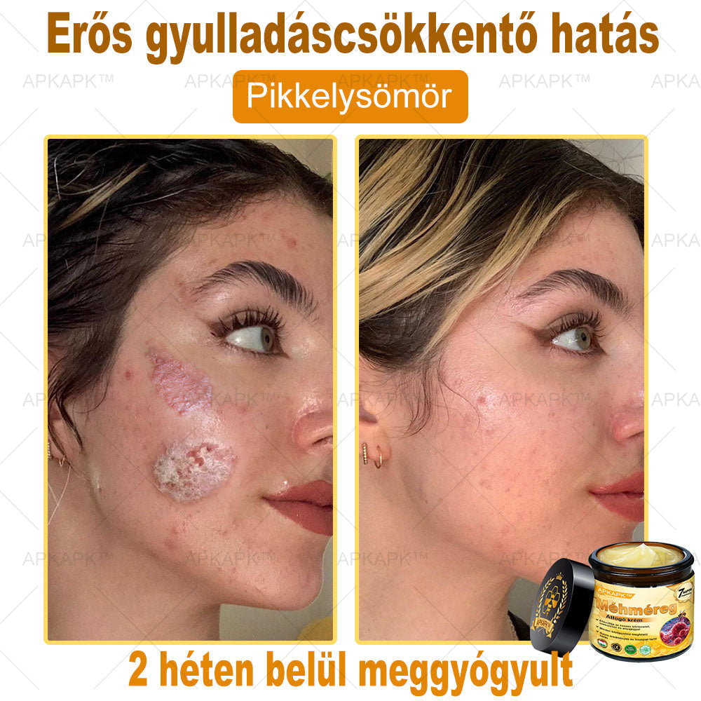 APKAPK®  Méhméreg krém a bőr megújítására 🐝 segít megoldani olyan bőrproblémákat, mint: ráncok, hegek, pigmentfoltok, striák, akné, pikkelysömör, ekcéma, bőrelváltozások, irritációk, gyulladások és egyéb bőrpanaszok.