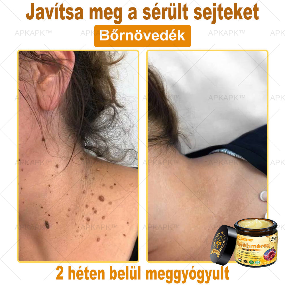 APKAPK®  Méhméreg krém a bőr megújítására 🐝 segít megoldani olyan bőrproblémákat, mint: ráncok, hegek, pigmentfoltok, striák, akné, pikkelysömör, ekcéma, bőrelváltozások, irritációk, gyulladások és egyéb bőrpanaszok.