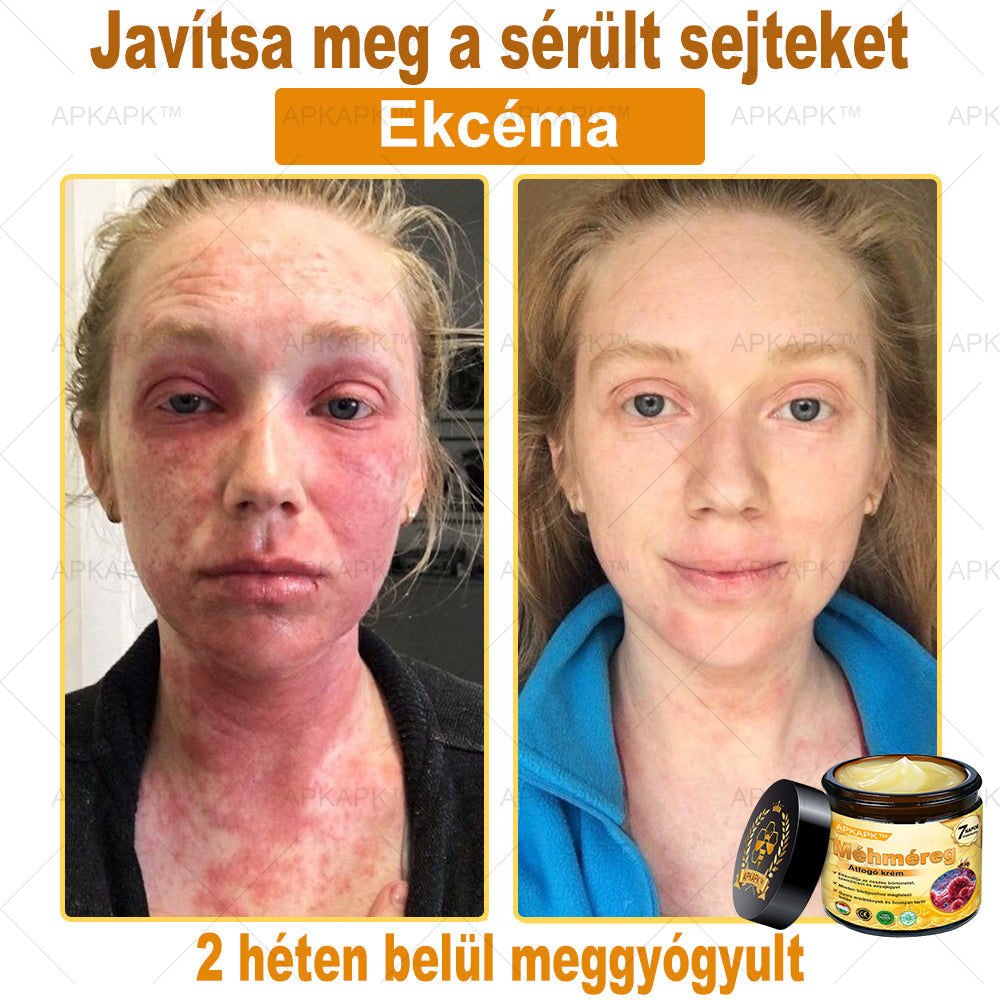 APKAPK®  Méhméreg krém a bőr megújítására 🐝 segít megoldani olyan bőrproblémákat, mint: ráncok, hegek, pigmentfoltok, striák, akné, pikkelysömör, ekcéma, bőrelváltozások, irritációk, gyulladások és egyéb bőrpanaszok.