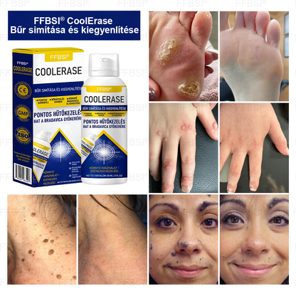 FFBSI® ❄ CoolErase Bőrregeneráló Spray (Szemölcsök, Hólyagok, Ekcéma, Pikkelysömör, Bőrkinövések, Akne, Bőrcímkék, Hegek, Anyajegyek)