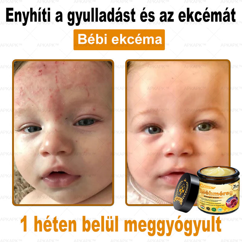 APKAPK®  Méhméreg krém a bőr megújítására 🐝 segít megoldani olyan bőrproblémákat, mint: ráncok, hegek, pigmentfoltok, striák, akné, pikkelysömör, ekcéma, bőrelváltozások, irritációk, gyulladások és egyéb bőrpanaszok.