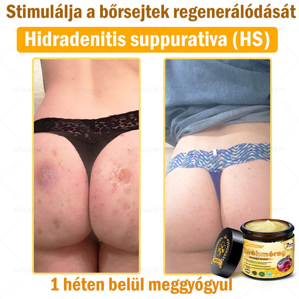 APKAPK®  Méhméreg krém a bőr megújítására 🐝 segít megoldani olyan bőrproblémákat, mint: ráncok, hegek, pigmentfoltok, striák, akné, pikkelysömör, ekcéma, bőrelváltozások, irritációk, gyulladások és egyéb bőrpanaszok.
