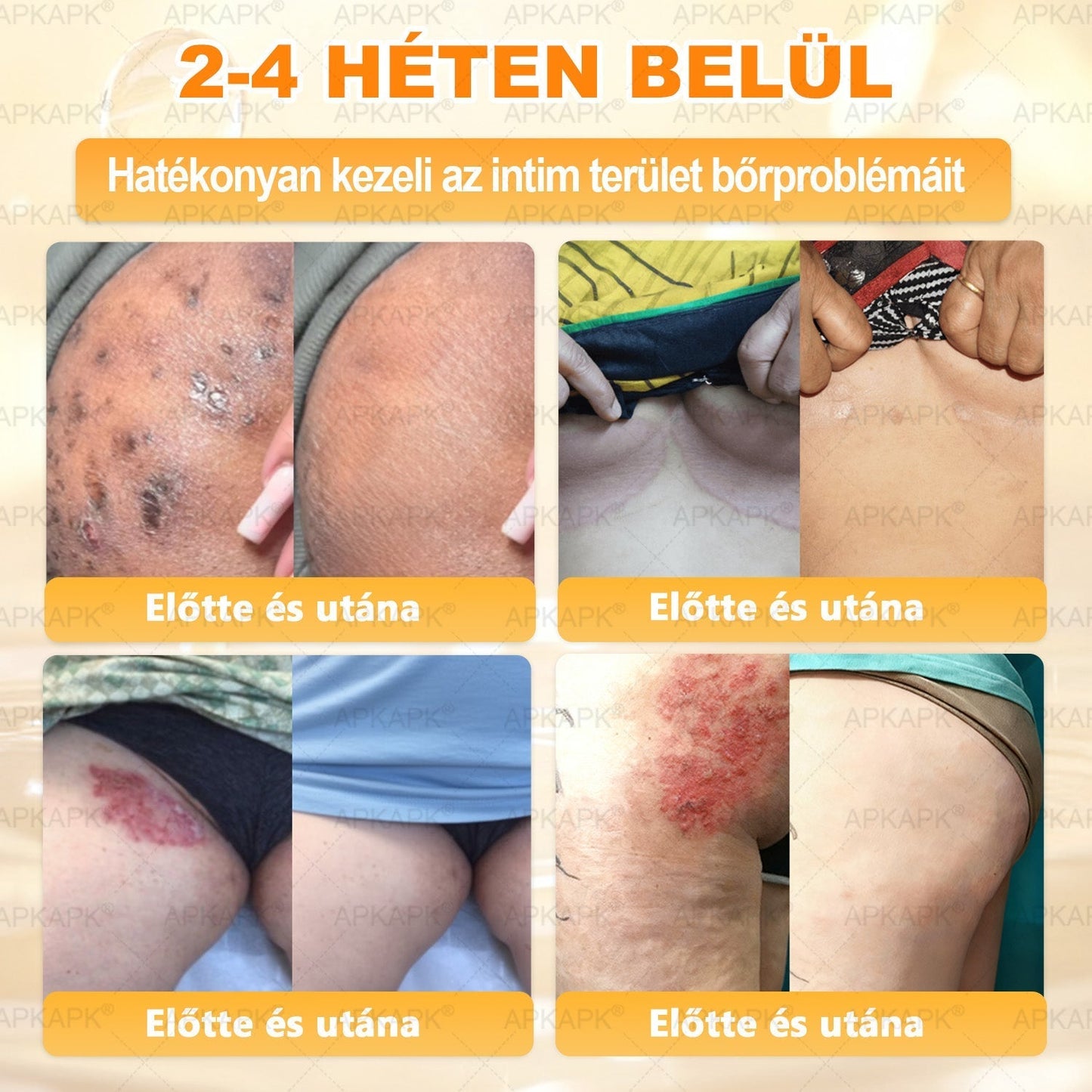 APKAPK®  Méhméreg krém a bőr megújítására 🐝 segít megoldani olyan bőrproblémákat, mint: ráncok, hegek, pigmentfoltok, striák, akné, pikkelysömör, ekcéma, bőrelváltozások, irritációk, gyulladások és egyéb bőrpanaszok.
