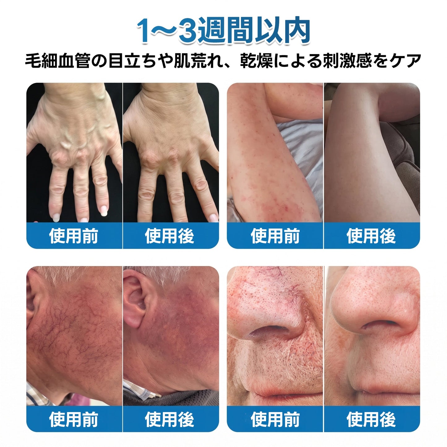 🇯🇵🏆✅️🏃 HAJUEI® VeinRepair マイクロニードルパッチロール ⚡ すばやくケア、効果を長くキープ