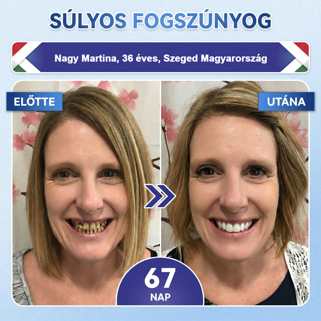 🦷HAJUEI® Tideglusib Fog & íny Javító mikrotűs tapasz | Fejlett őssejt-aktiváló fogcsíkok (újjáépíti a fogzománcot és a dentint • erősíti az ínyt • megszünteti a fogkövet és a szagokat • megállítja a fogérzékenységet)
