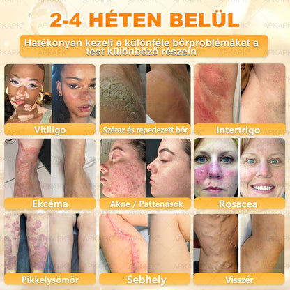 APKAPK®  Méhméreg krém a bőr megújítására 🐝 segít megoldani olyan bőrproblémákat, mint: ráncok, hegek, pigmentfoltok, striák, akné, pikkelysömör, ekcéma, bőrelváltozások, irritációk, gyulladások és egyéb bőrpanaszok.