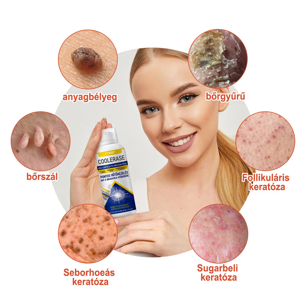 FFBSI® ❄ CoolErase Bőrregeneráló Spray (Szemölcsök, Hólyagok, Ekcéma, Pikkelysömör, Bőrkinövések, Akne, Bőrcímkék, Hegek, Anyajegyek)